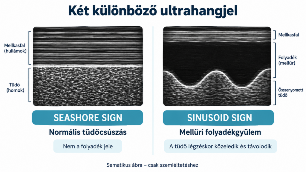A mellkas ultrahanggal látható képei